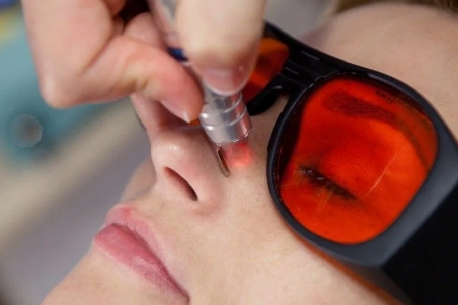 Удаление звездочек и сосудов лазером